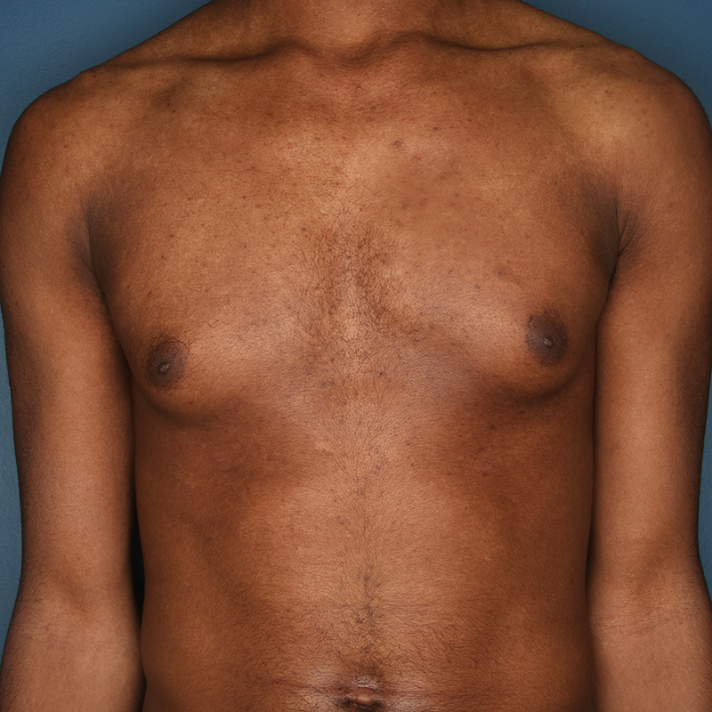 Case--19624 | Before Cosmetic Breast Surgery