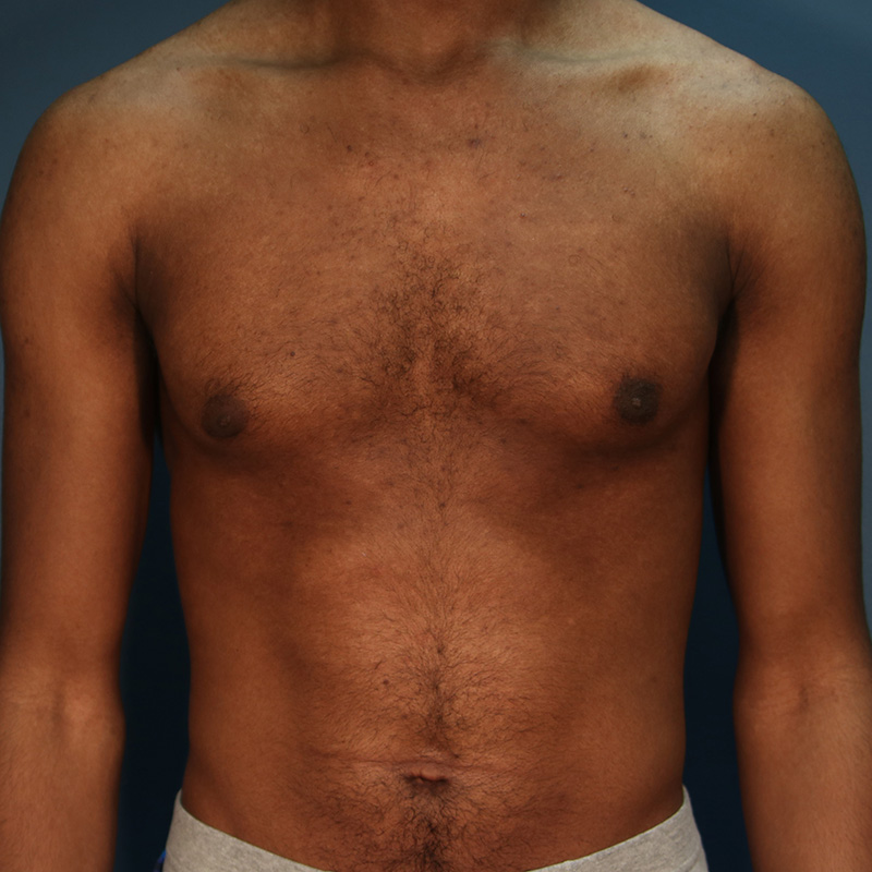 Case--19624 | After Cosmetic Breast Surgery