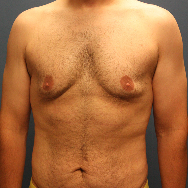 Case--19724 | Before Cosmetic Breast Surgery