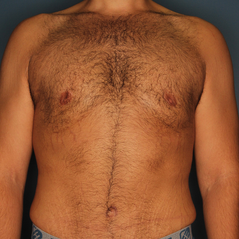 Case--19724 | After Cosmetic Breast Surgery