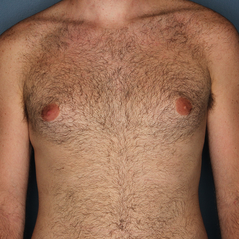 Case--19824 | Before Cosmetic Breast Surgery