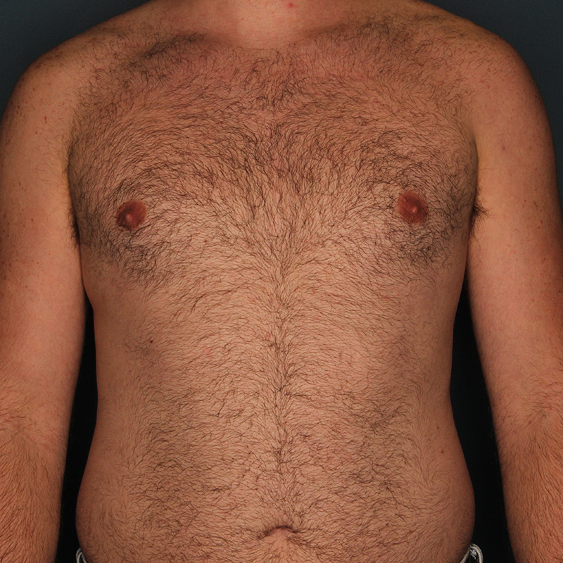 Case--19824 | After Cosmetic Breast Surgery