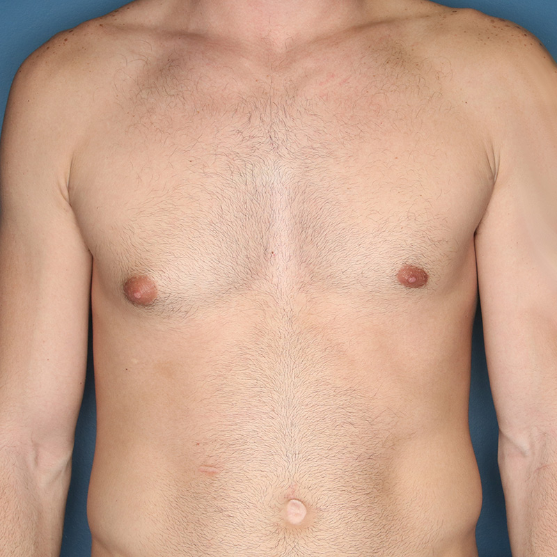 Case--19924 | Before Correction of Gynecomastia (contouring of the male chest)