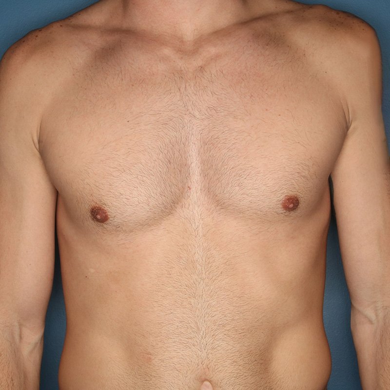 Case--19924 | After Correction of Gynecomastia (contouring of the male chest)