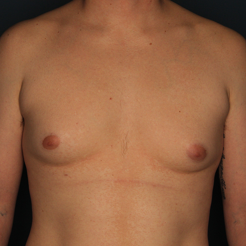 Case--20024 | Before Cosmetic Breast Surgery