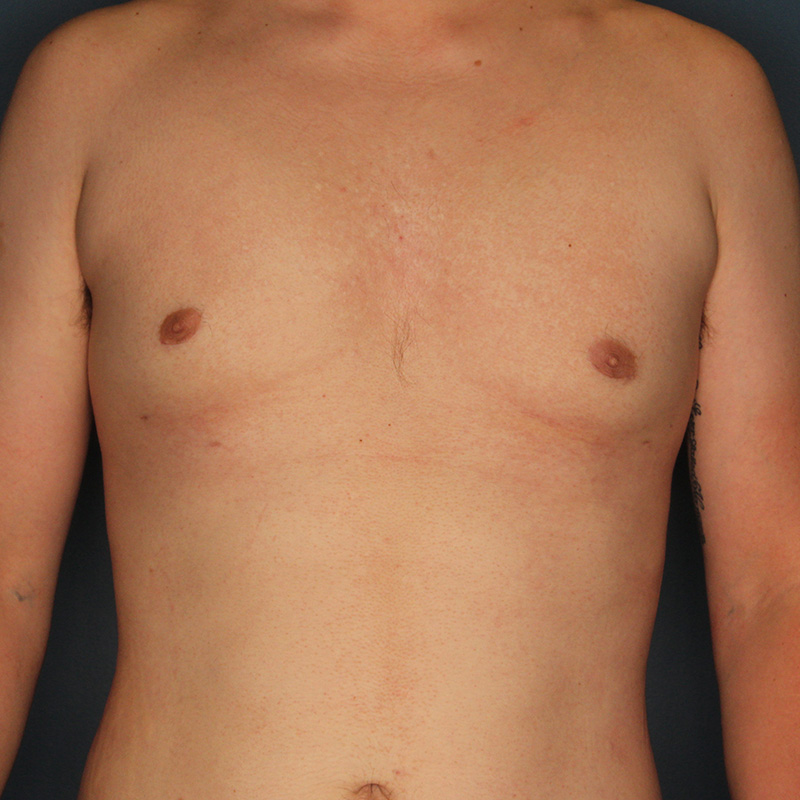 Case--20024 | After Cosmetic Breast Surgery