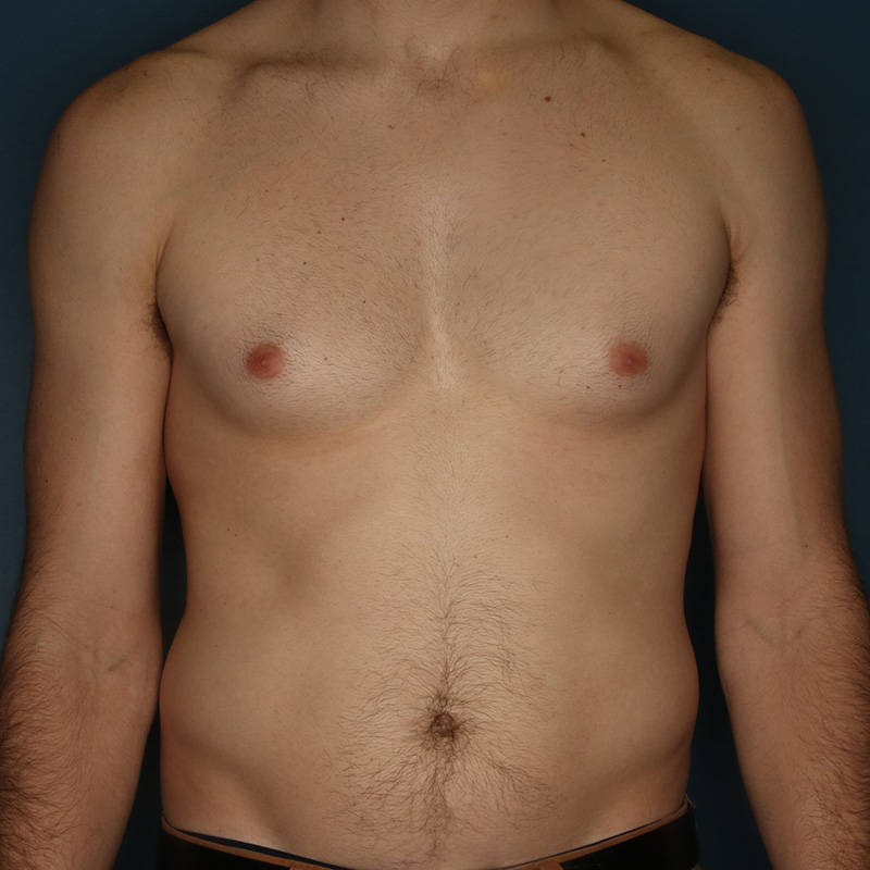 Case--20124 | Before Cosmetic Breast Surgery