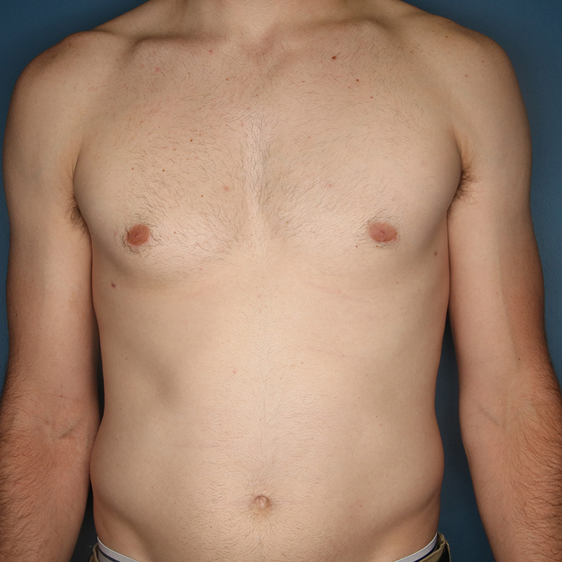 Case--20124 | After Cosmetic Breast Surgery