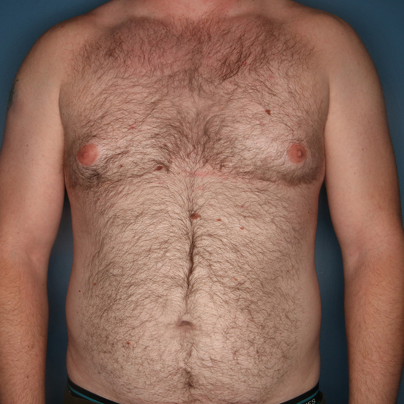 Case--20224 | Before Cosmetic Breast Surgery