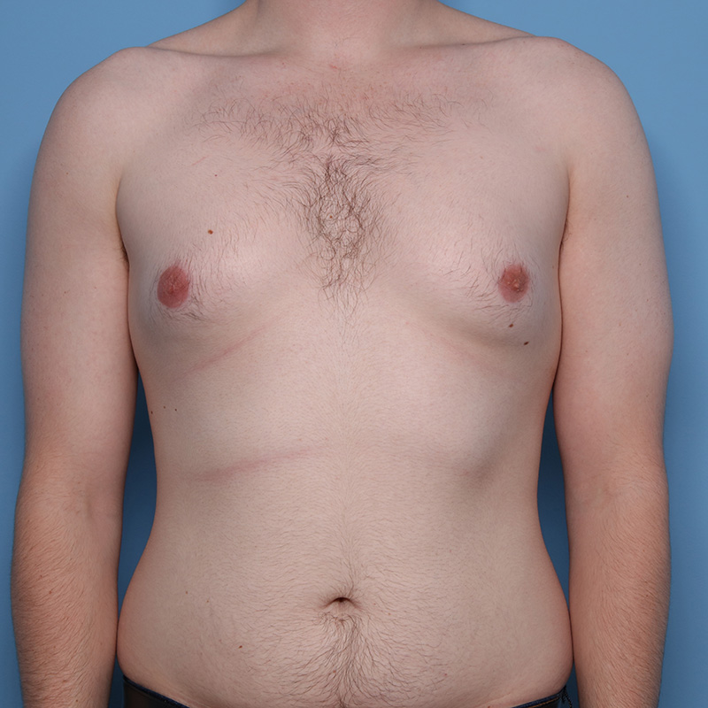 Case--20324 | Before Cosmetic Breast Surgery