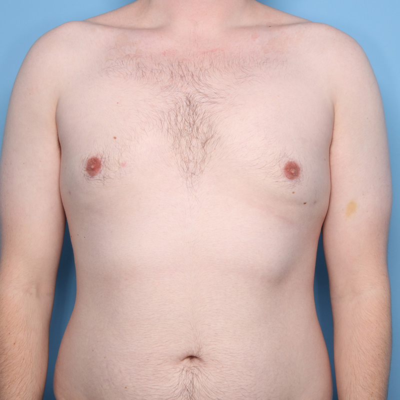 Case--20324 | After Cosmetic Breast Surgery