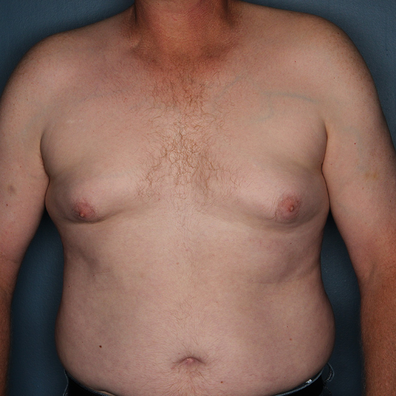 Case--20424 | Before Cosmetic Breast Surgery