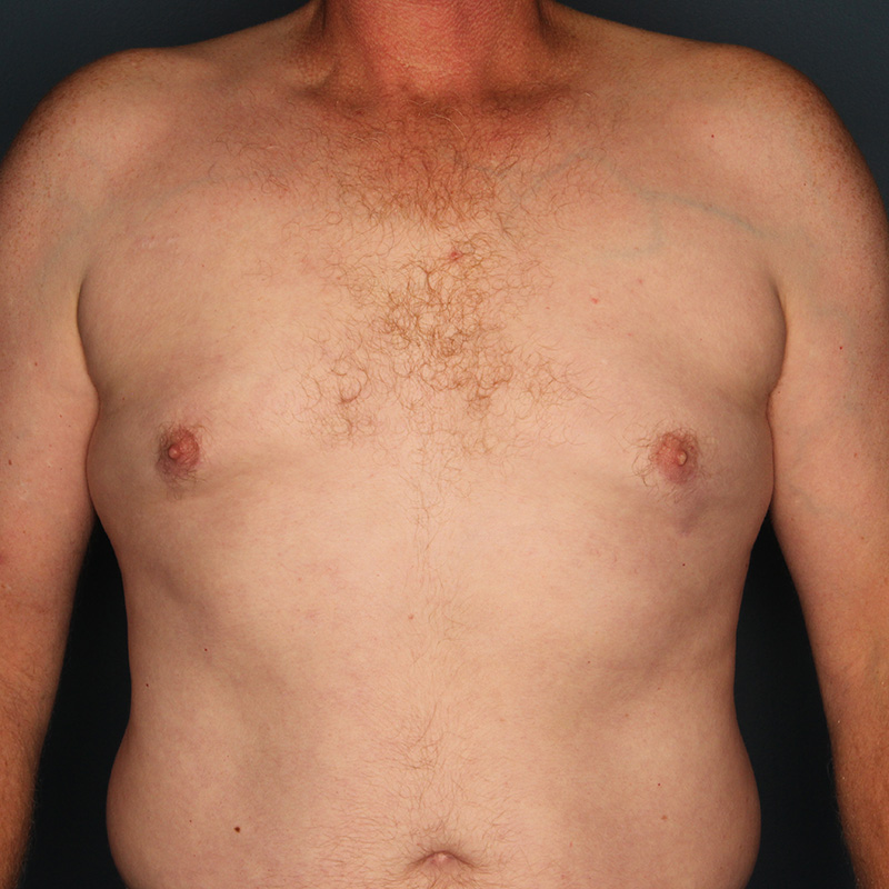 Case--20424 | After Cosmetic Breast Surgery