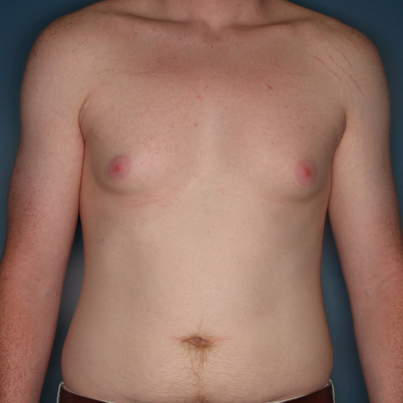 Case--20524 | Before Cosmetic Breast Surgery