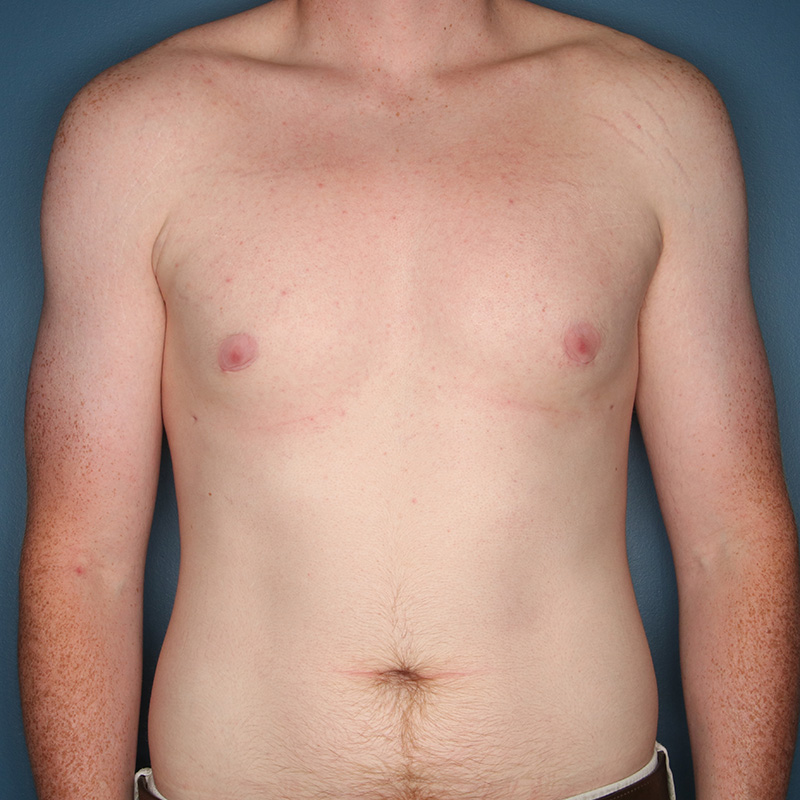 Case--20524 | After Cosmetic Breast Surgery