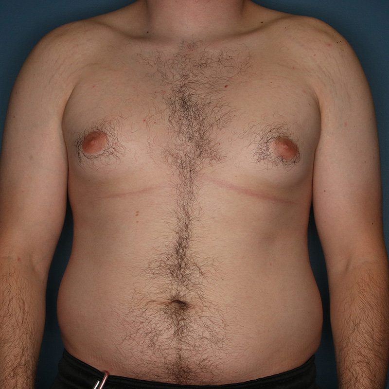 Case--20724 | Before Correction of Gynecomastia (contouring of the male chest)