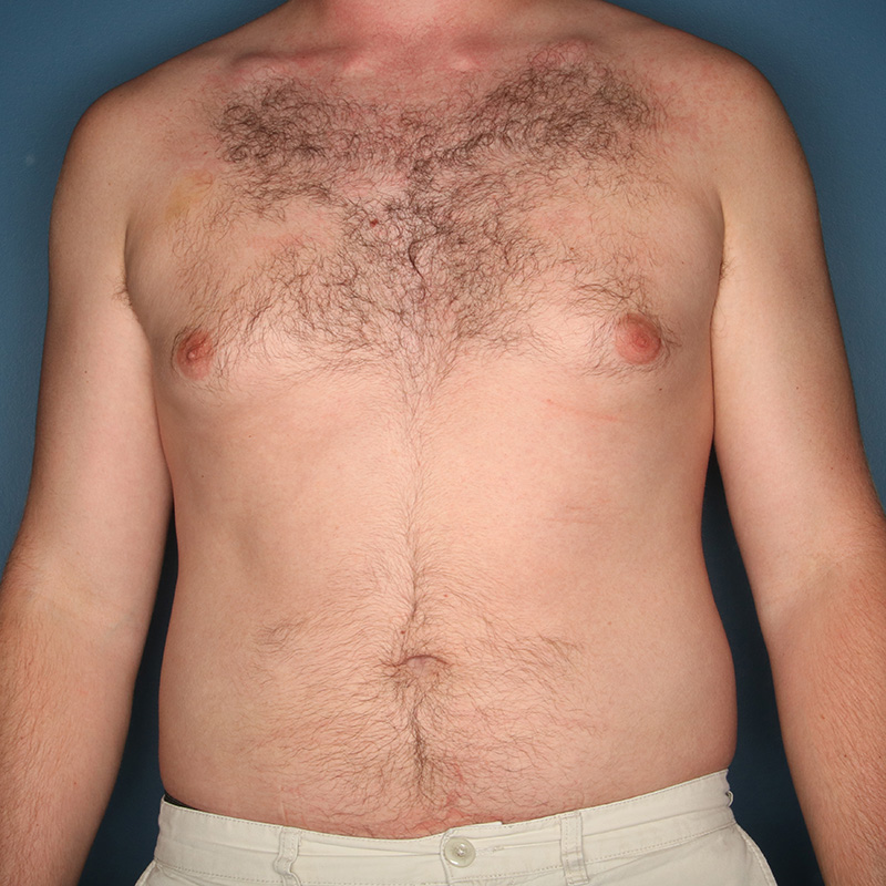 Case--20824 | Before Cosmetic Breast Surgery