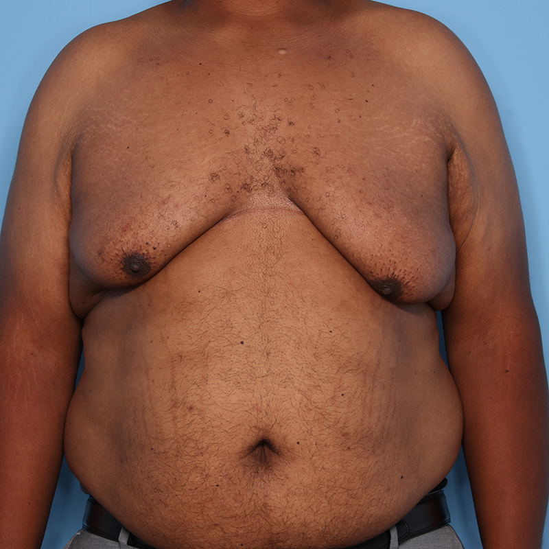 Case--21024 | Before Cosmetic Breast Surgery