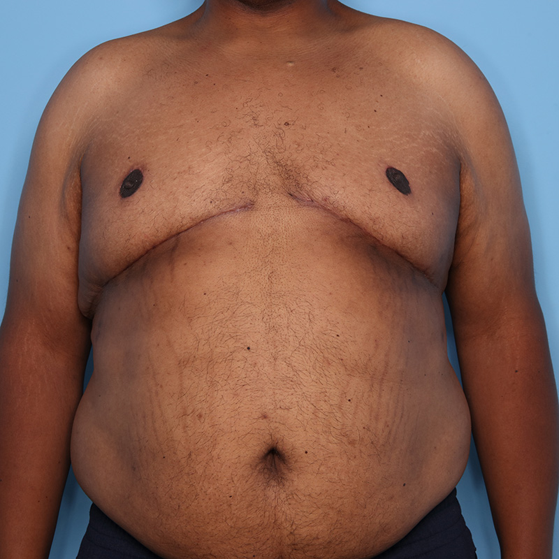 Case--21024 | After Cosmetic Breast Surgery