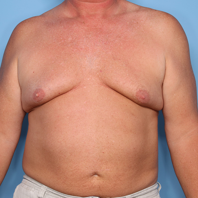 Case--21124 | Before Cosmetic Breast Surgery