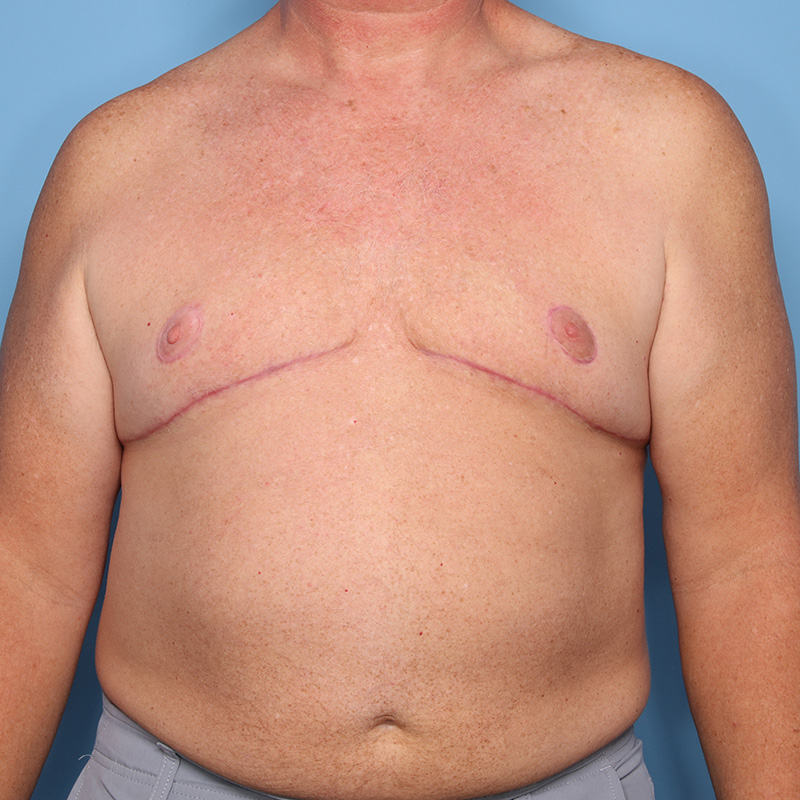 Case--21124 | After Cosmetic Breast Surgery