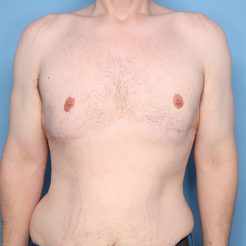 Case--21224 | After Cosmetic Breast Surgery