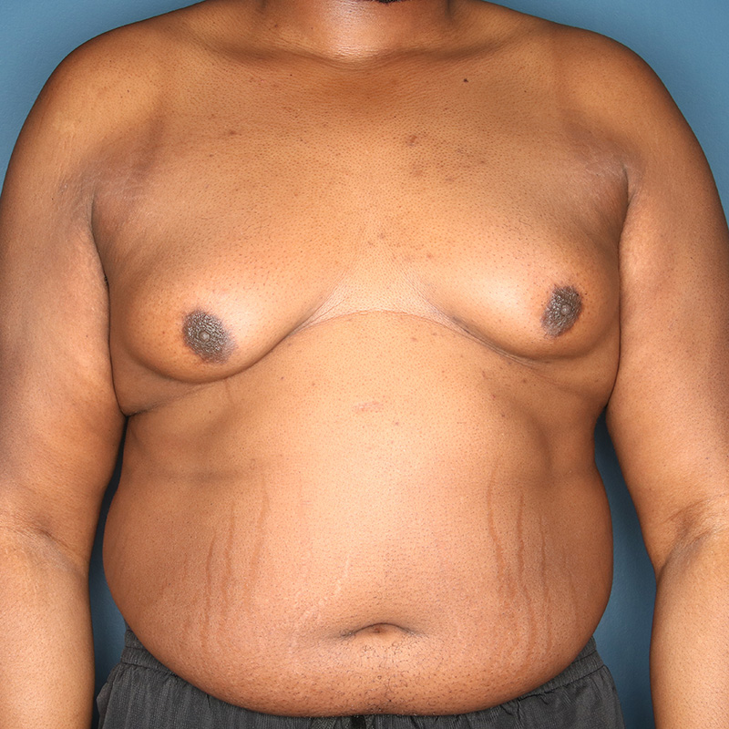 Case--21324 | Before Cosmetic Breast Surgery