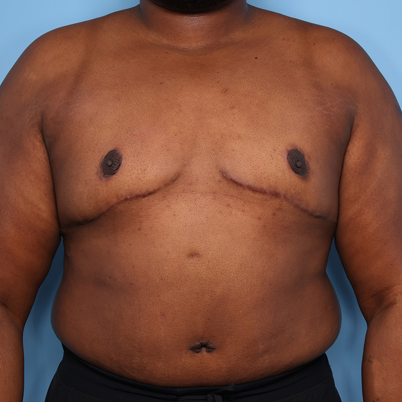 Case--21324 | After Cosmetic Breast Surgery