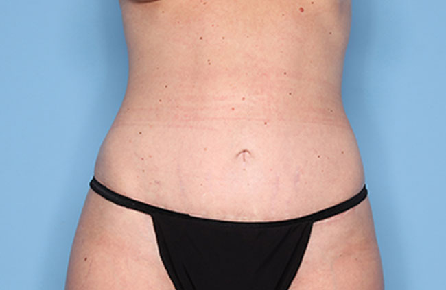Case--21424 | After Mini Abdominoplasty