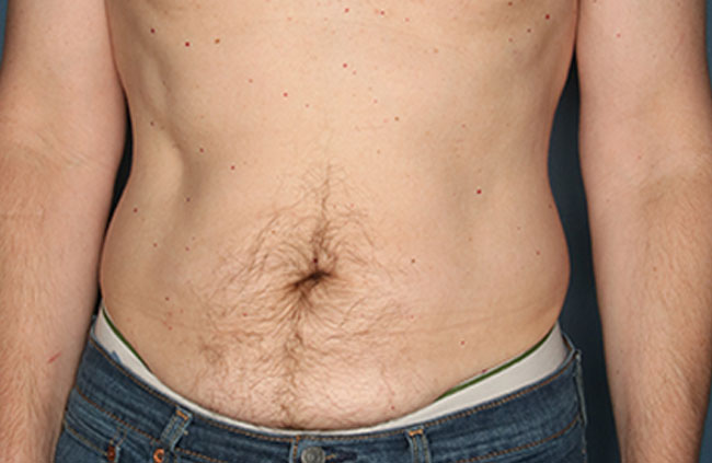 Case--21624 | Before Mini Abdominoplasty