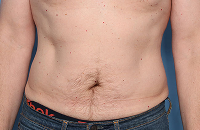 Case--21624 | After Mini Abdominoplasty