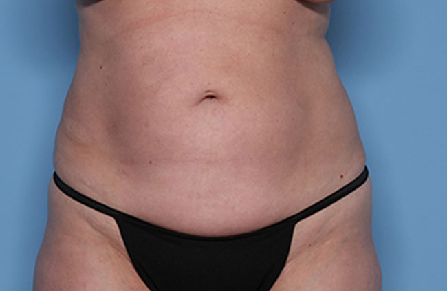 Case--21724 | Before Mini Abdominoplasty