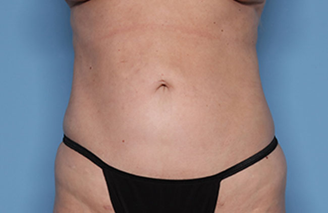 Case--21724 | After Mini Abdominoplasty