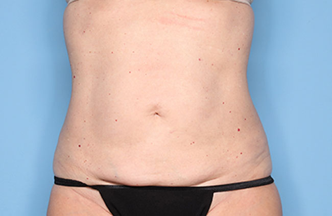 Case--21824 | Before Mini Abdominoplasty