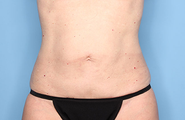 Case--21824 | After Mini Abdominoplasty