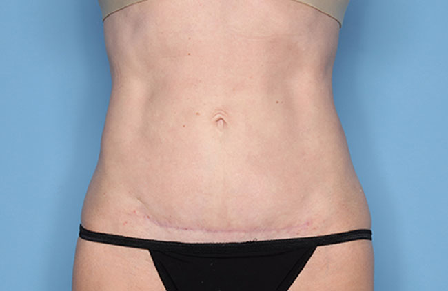 Case--21924 | After Mini Abdominoplasty