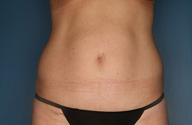 Case--22024 | Before Mini Abdominoplasty