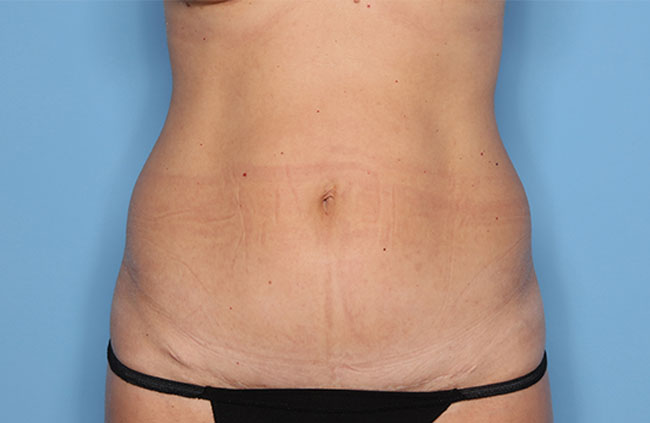 Case--22024 | After Mini Abdominoplasty