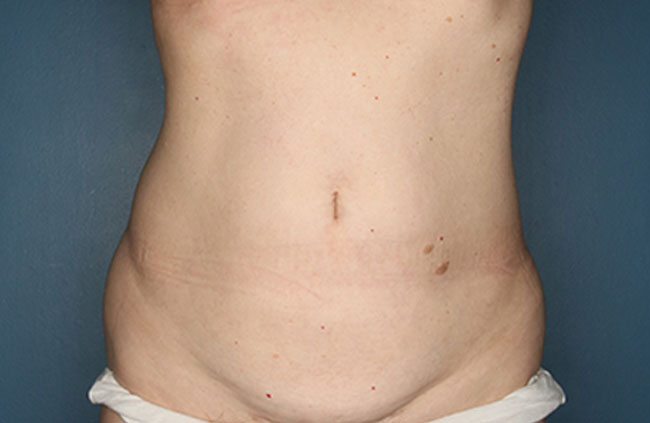 Case--22124 | Before Mini Abdominoplasty