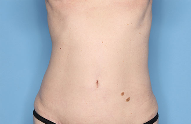 Case--22124 | After Mini Abdominoplasty