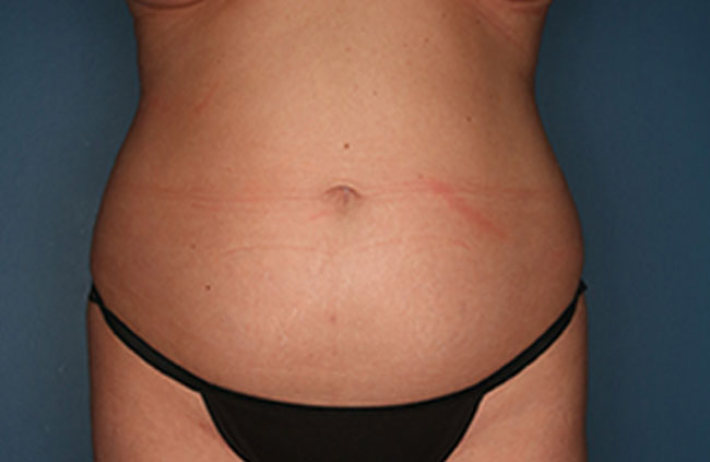 Case--22224 | Before Mini Abdominoplasty