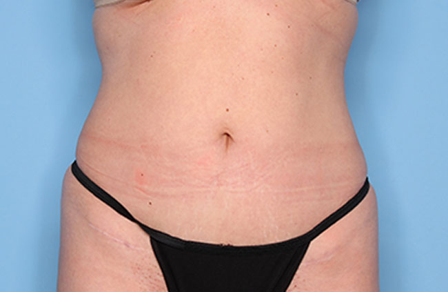 Case--22224 | After Mini Abdominoplasty
