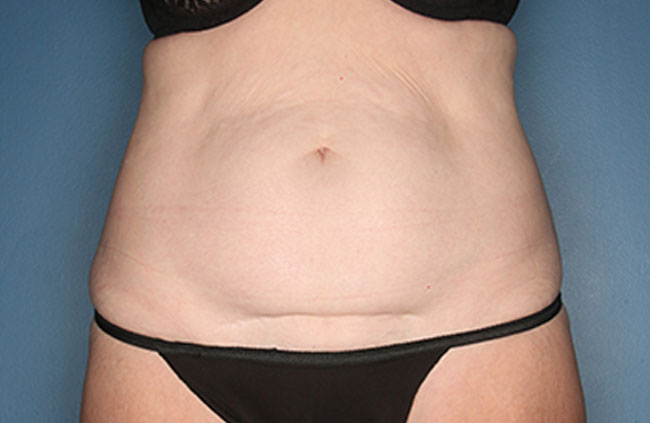Case--22324 | Before Mini Abdominoplasty