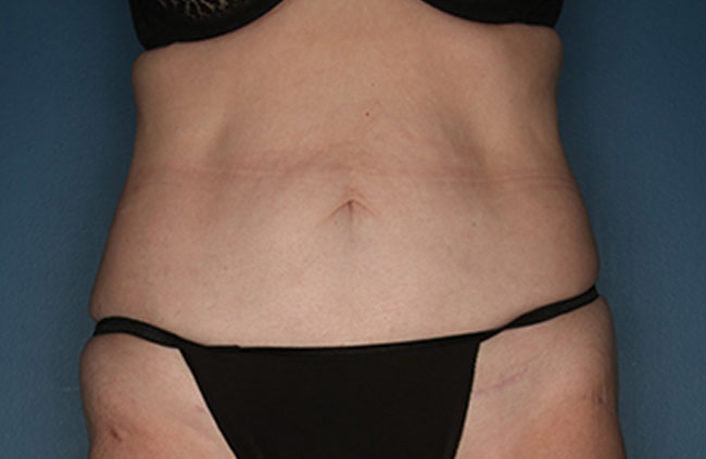 Case--22324 | After Mini Abdominoplasty