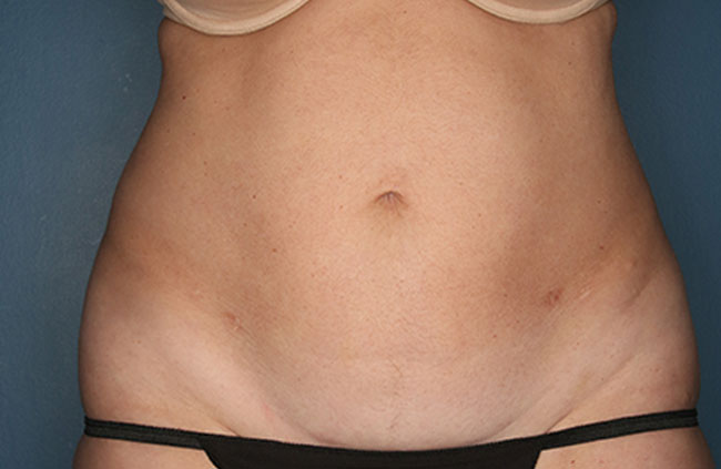 Case--22424 | Before Mini Abdominoplasty