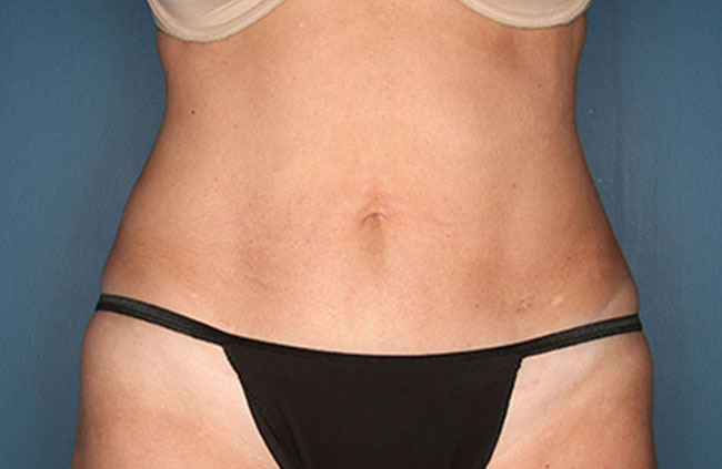 Case--22424 | After Mini Abdominoplasty