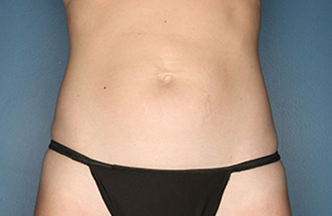 Case--22524 | Before Mini Abdominoplasty