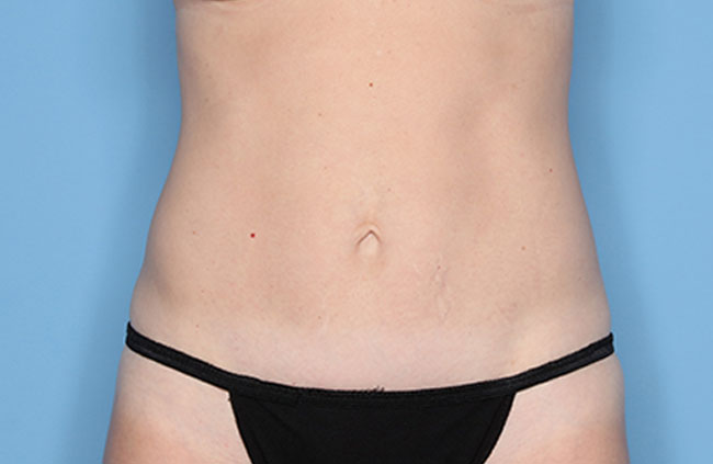Case--22524 | After Mini Abdominoplasty