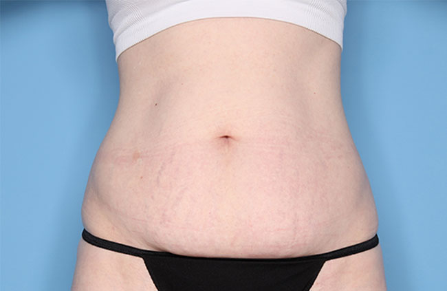 Case--22624 | Before Mini Abdominoplasty