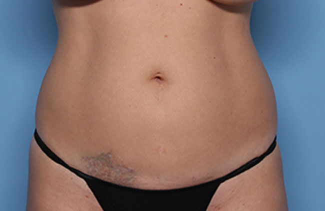 Case--22724 | Before Mini Abdominoplasty